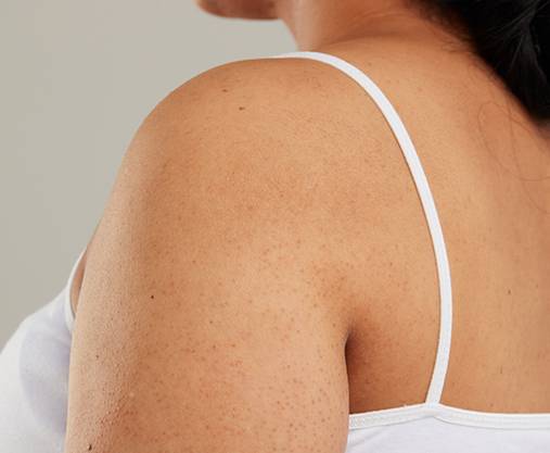 Dry Skin